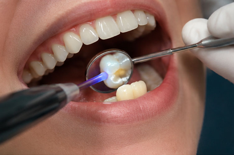 Tooth Coloured Composite Laser Fillings