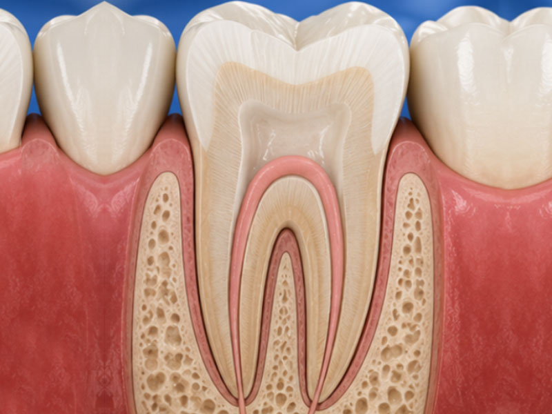 Single Sitting Root Canal